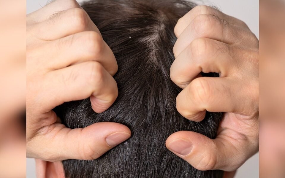 Is Dandruff Contagious?